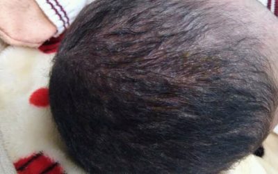 Does Cradle Cap Affect Hair Growth?